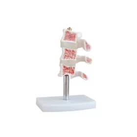 modelo-de-corte-de-vertebras-evolucion-de-osteoporosis